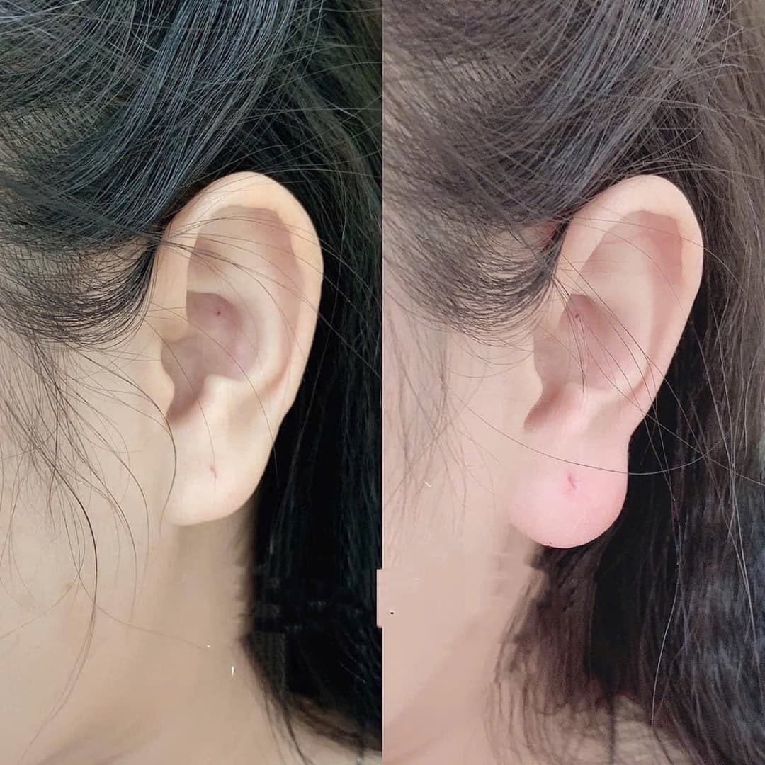 Căn chỉnh tai tài lộc – Dáng tai hài hòa tự nhiên