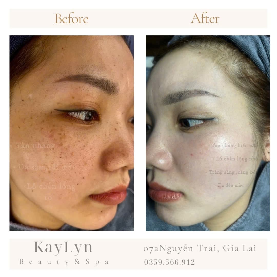 Điều trị nám và tàn nhang – Da sáng đều màu