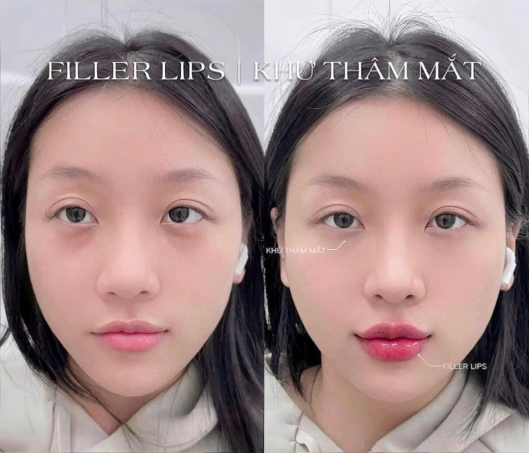 Combo Full Face – Nâng cơ và trẻ hoá tổng thể