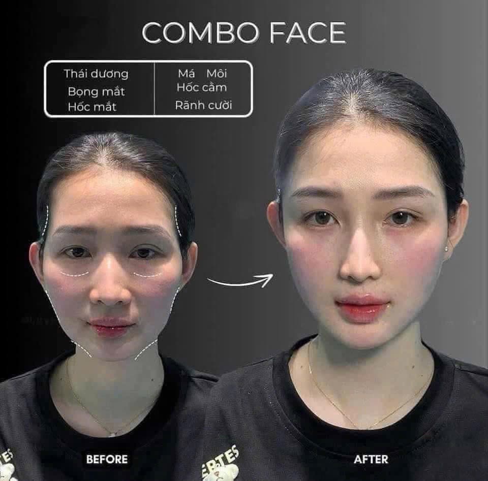 Combo Full Face – Cải thiện đường nét gương mặt
