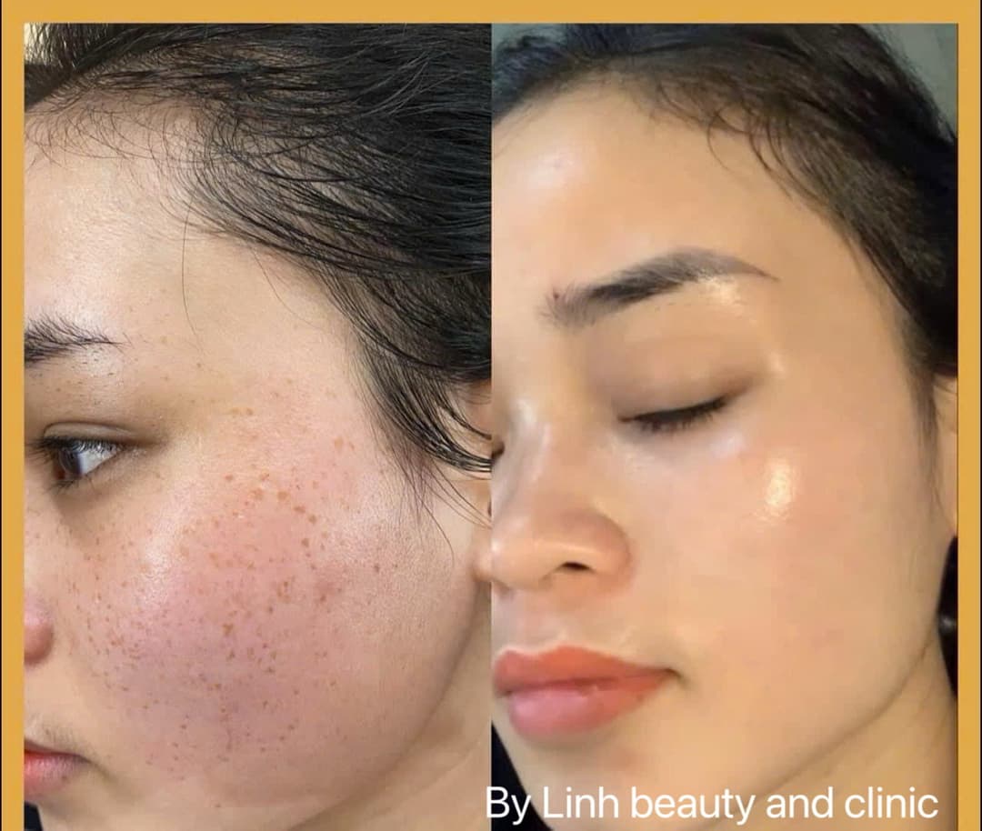 Điều trị nám, tàn nhang – Thu nhỏ lỗ chân lông