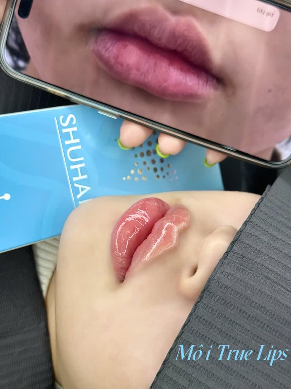 Filler môi – Dáng môi căng mọng tự nhiên