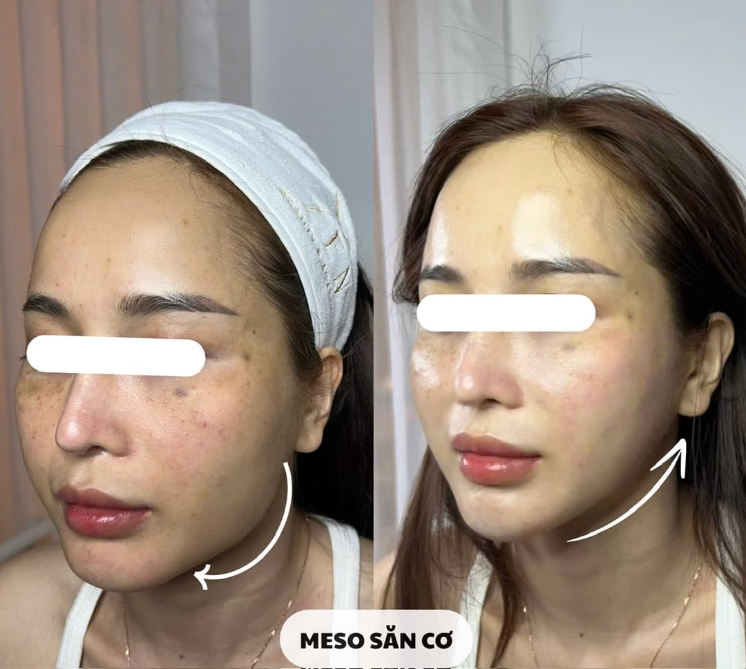 Meso săn cơ – Da săn chắc và đàn hồi hơn