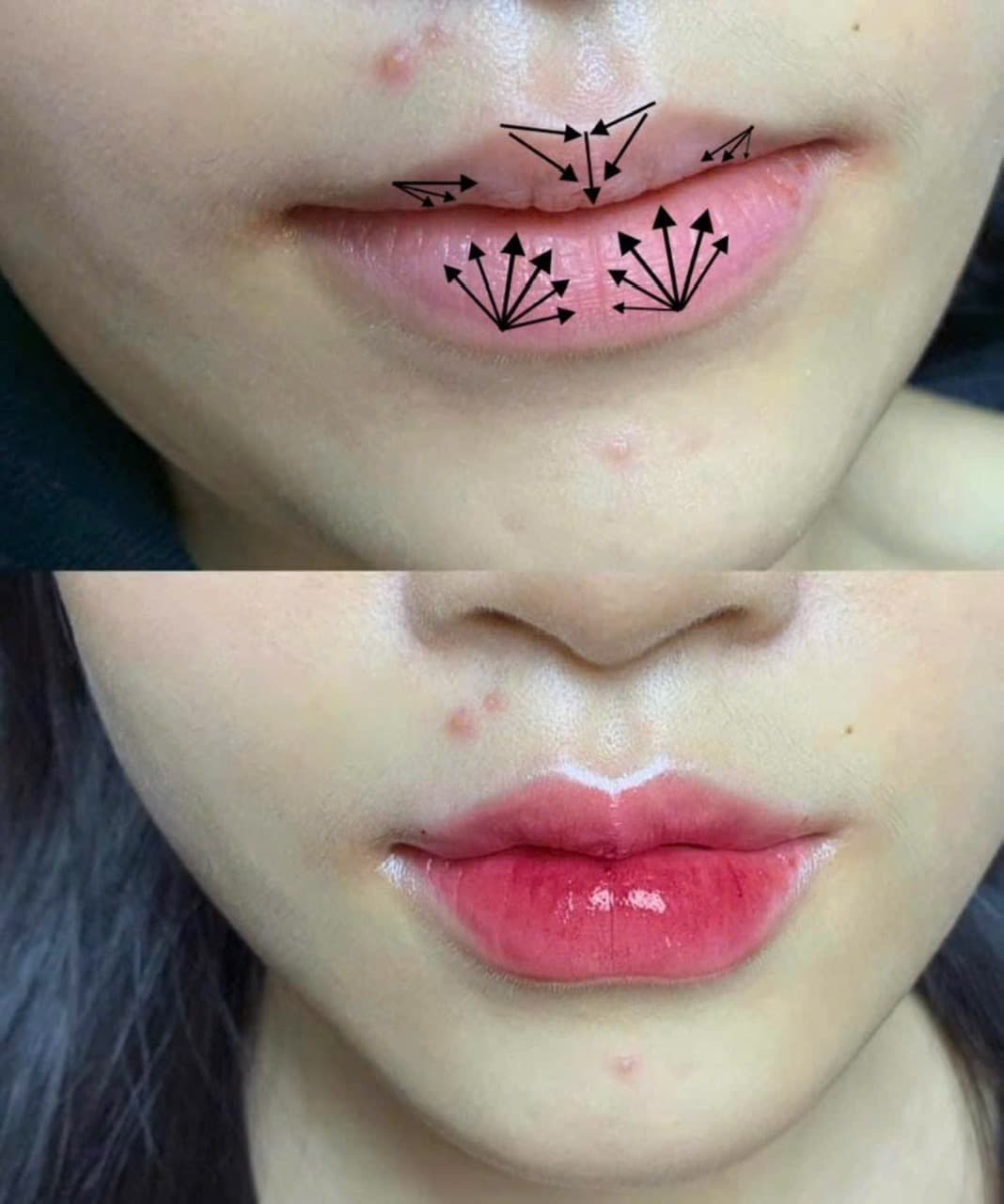 Filler môi – Cải thiện môi mỏng, tạo form hài hòa