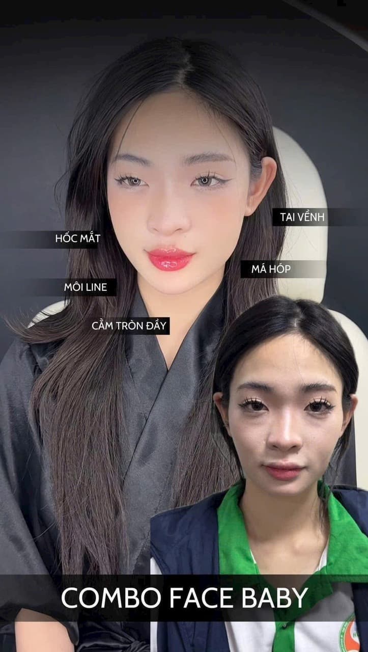 Combo Full Face – Trẻ hoá toàn diện gương mặt