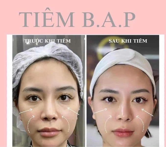 B.A.P Trẻ Hoá Da – Nâng Cơ Tự Nhiên Tại Kaylyn Spa Pleiku Gia Lai