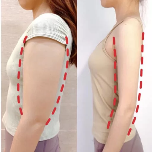 Botox Hạ Cầu Vai – Thon Bắp Tay Tại Kaylyn Spa Pleiku Gia Lai