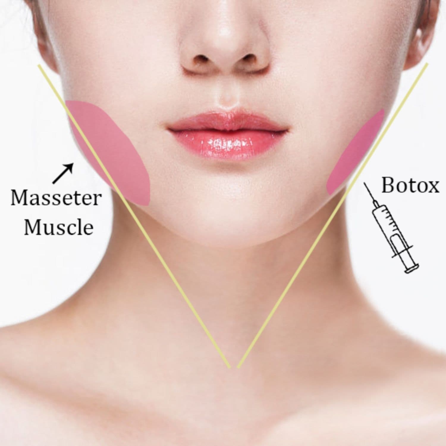 Botox Thon Gọn Hàm – Tạo Gương Mặt V-Line Tự Nhiên Tại Kaylyn Spa Pleiku