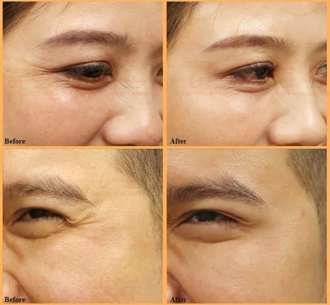 Botox Xóa Nhăn Trán – Khóe Mắt – Rãnh Cười Tại Kaylyn Spa Pleiku