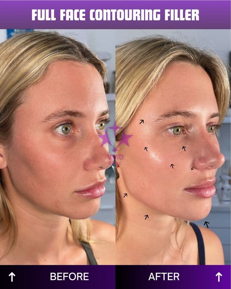 Filler Full Face – Tạo hình gương mặt tự nhiên tại Kaylyn Spa Pleiku