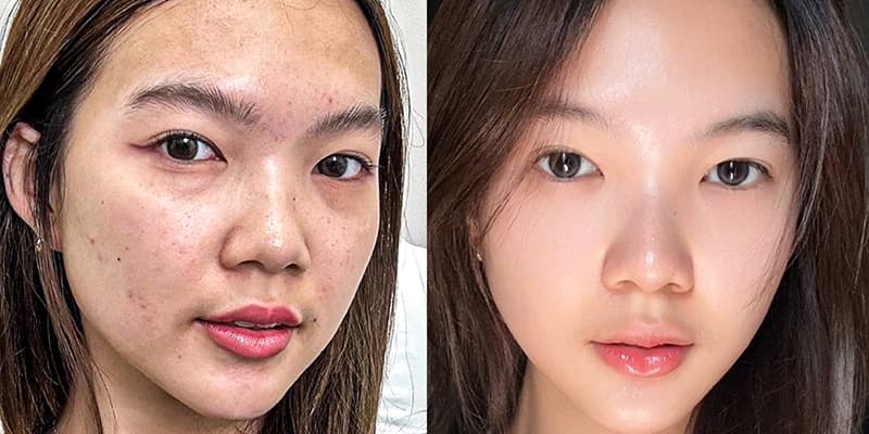 Meso Săn Cơ Mặt – Nâng Cơ Trẻ Hóa Da Tại Pleiku