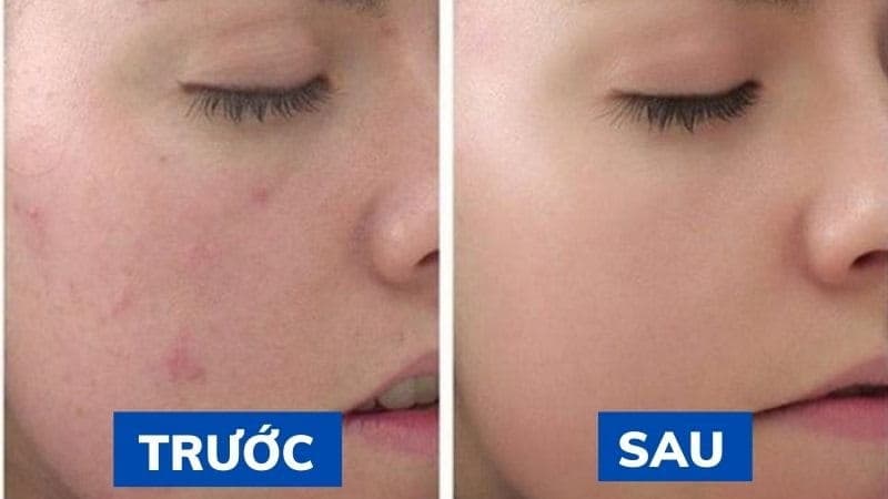 Peel Mụn Giảm Mụn Hiệu Quả – Làm Sạch Sâu Da Tại Kaylyn Spa Pleiku Gia Lai