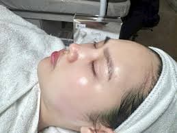Peel Trắng Da Làm Sáng Da – Đều Màu Da Tại Kaylyn Spa Pleiku Gia Lai