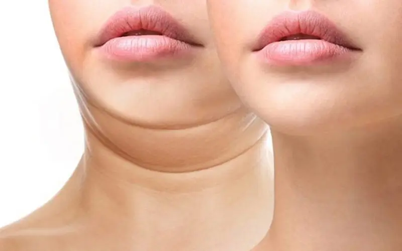 Meso Tan Mỡ Nọng Cằm & Bụng – Giải Pháp Giảm Mỡ Không Phẫu Thuật Tại Pleiku